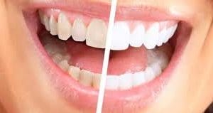 dientes blanqueamiento