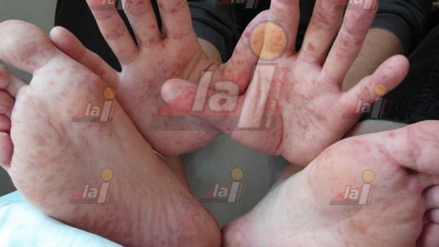 Coxsackie Seybaplaya