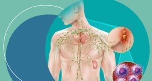 Día Mundial del Linfoma