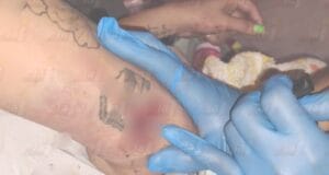 Mujer ebria se clava reja de metal en su codo en Ciudad Caucel