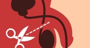 Vasectomía gratis: Dónde y cuándo