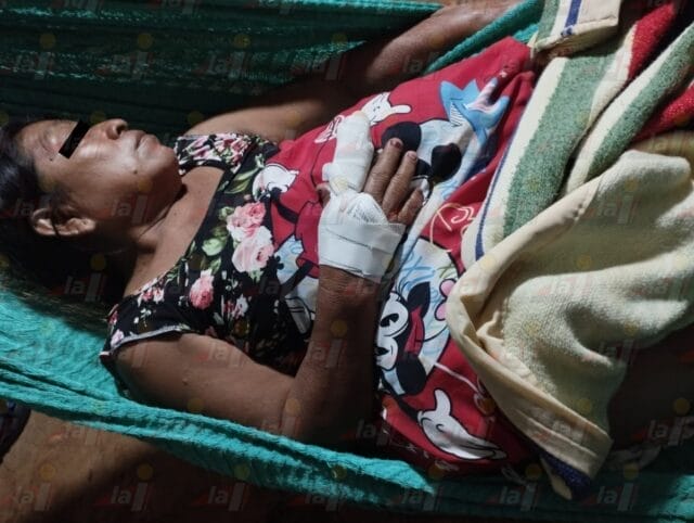 Perros pitbull atacan a abuelita en Hecelchakán: podría perder un dedo