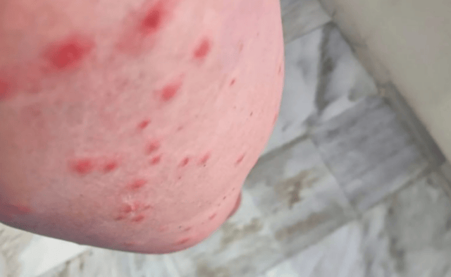 mujer es atacada por mosquitos