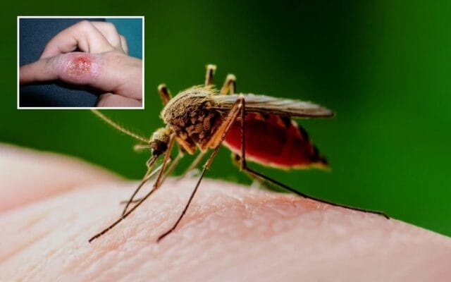 casos de leishmaniasis Campeche mosca chiclera