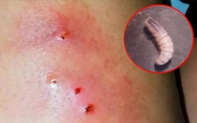 miasis humanos Campeche gusano barrenador Salud Campeche casos