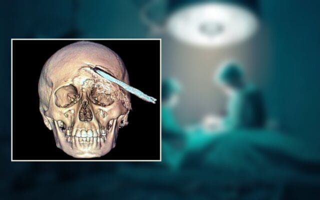 IMSS Yucatán cráneo coa