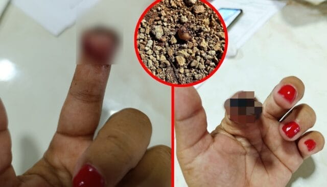 Mujer acusa que le arrancaron parte de un dedo durante postparto y que el caso no avanza