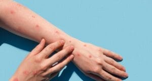 Península de Yucatán cerró 2025 con aumento de casos de viruela símica