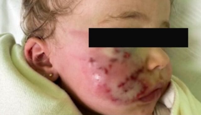 Ataque de perro deja grave a niña de 1 año en parque: estuvo a nada de perder un ojo