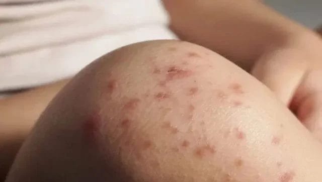 Yucatán confirma cuatro casos de sarampión y refuerza vacunación ante brote